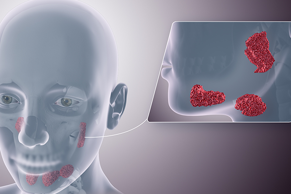 Salivary Gland Surgery